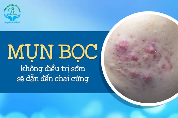 Hình ảnh mô tả các giai đoạn phát triển của mụn bọc, cần có cách trị mụn bọc từ bên trong phù hợp