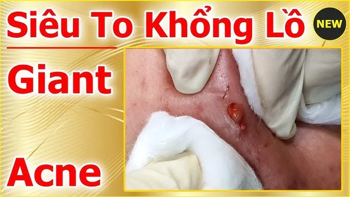 Cach Tri Tham Mun Nhot O Mong Dut Diem Hieu Qua Nhat Image 1