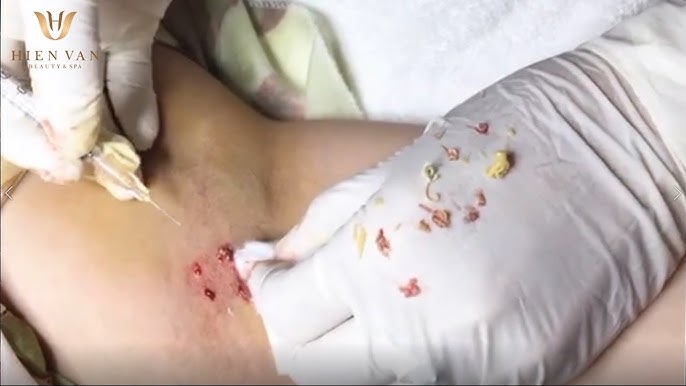 Cách trị thâm mụn nhọt ở mông dứt điểm, hiệu quả nhất Cach Tri Tham Mun Nhot O Mong Dut Diem Hieu Qua Nhat Image 3