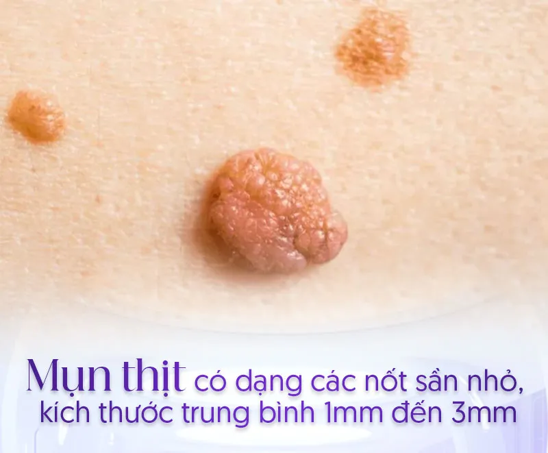 Hình ảnh mụn thịt ở môi và các cách trị mụn thịt ở môi hiệu quả