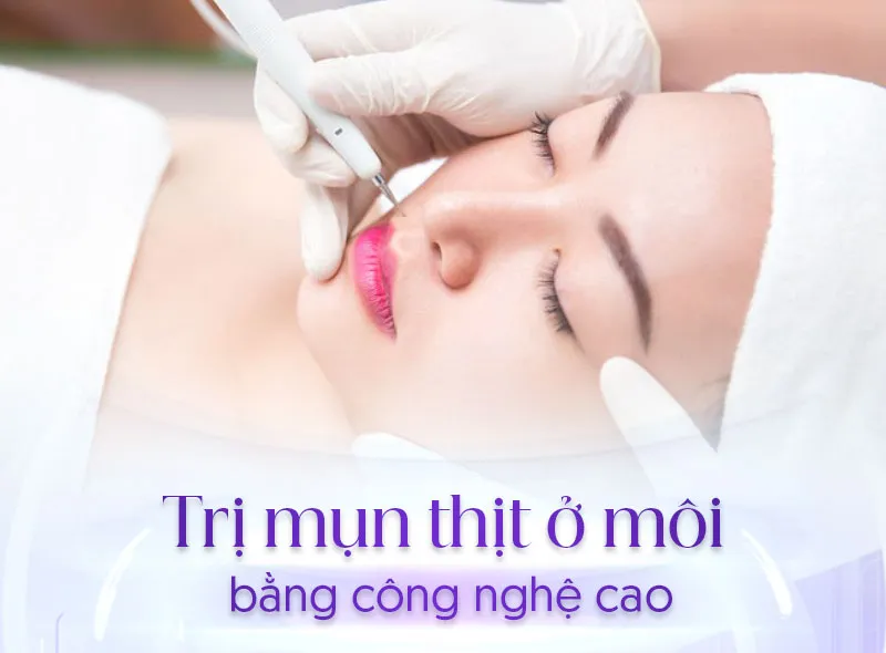 Công nghệ laser là cách trị mụn thịt ở môi tiên tiến nhất hiện nay