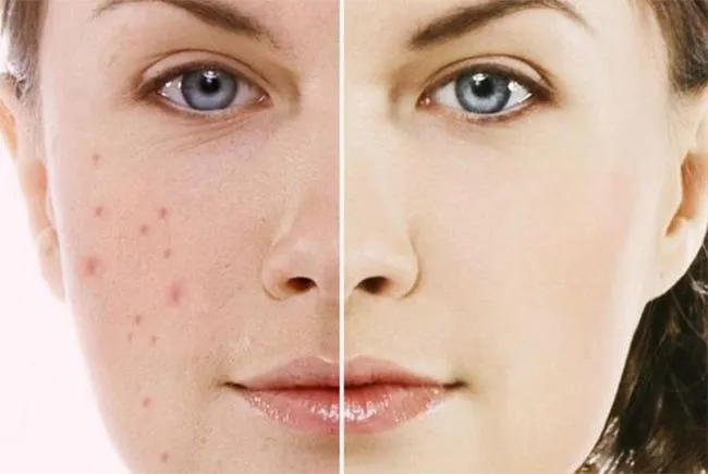 Làn da bị mụn đầu đen và các tác nhân gây mụn