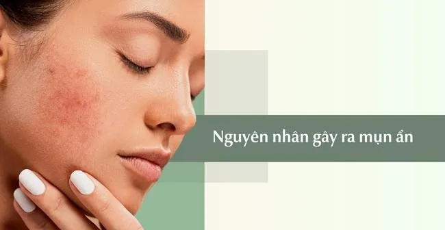 Mụn ẩn dưới da nhạy cảm