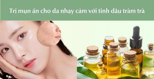 Trị mụn ẩn da nhạy cảm bằng tinh dầu tràm trà