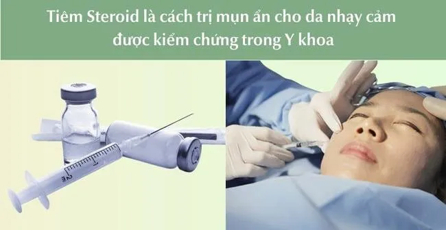 Tiêm Steroid điều trị mụn ẩn chuyên nghiệp