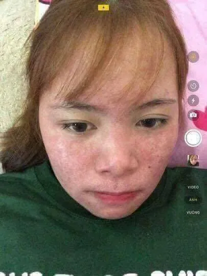 Hiệu quả trị mụn Thanh Mộc Hương sau giai đoạn bong tróc da