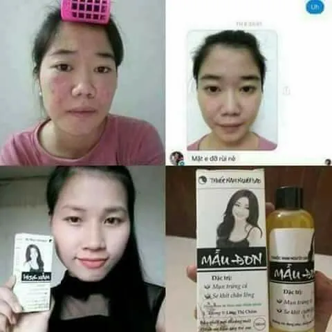 Hình ảnh thực tế quá trình đẩy nhân mụn khi dùng Thanh Mộc Hương