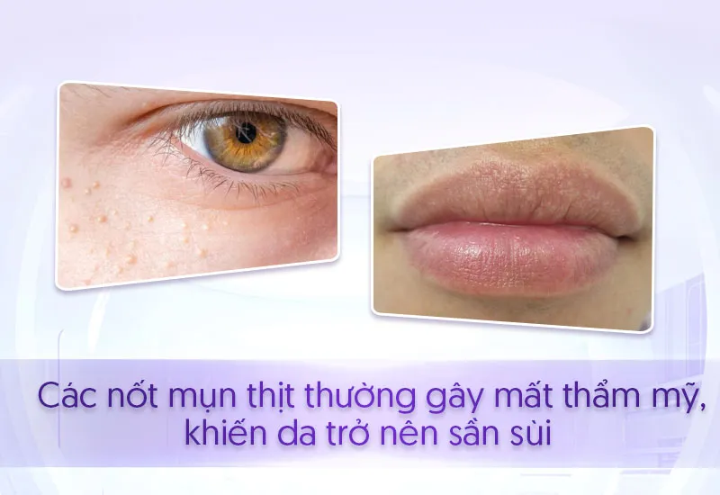 Chi phí và các phương pháp cách trị mụn thịt ở môi chuyên nghiệp